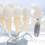 Implanty zębów ze Szczecina